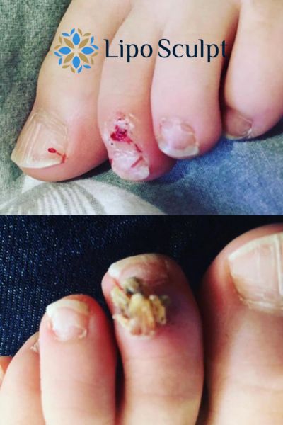Wart removal customer results from Lipo Sculpt Wrexham